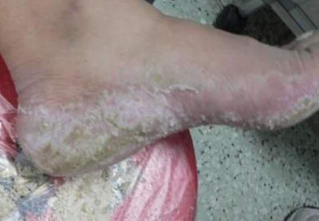 青岛脚气长期不治疗很可能会引起灰指甲