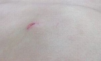 青岛皮下脂肪瘤怎么治疗