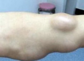 青岛皮下脂肪瘤治疗的手法有什么