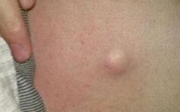 青岛什么治疗的手法预防乳腺脂肪瘤