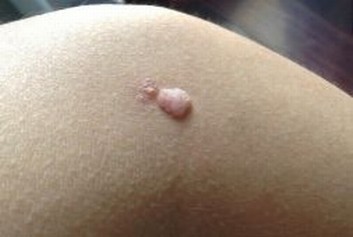 乳房脂肪瘤的临床症状有哪些