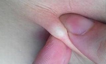 乳腺脂肪瘤的疾病介