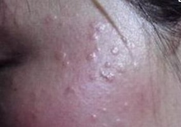 {文章标乳腺脂肪瘤的临床症状是怎样的呢题}