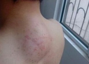 乳腺脂肪瘤的症状有什么