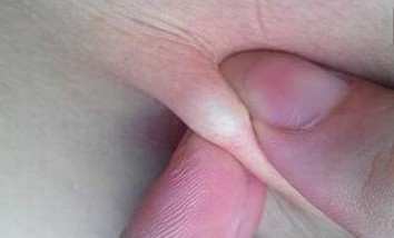 生活中应该怎样的预防乳房脂肪瘤