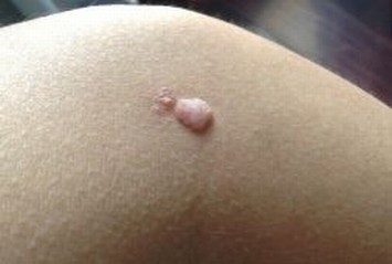 怎样有效的预防脂肪瘤的发生