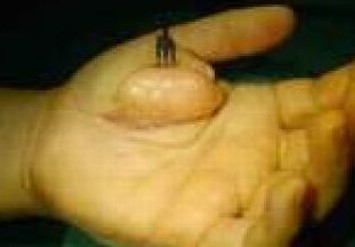 怎样预防脂肪瘤