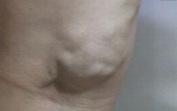 怎样预防脂肪瘤的发生