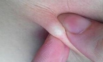 肥胖患者易患脂肪瘤