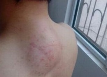 肝上的脂肪瘤应怎样调养