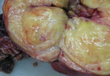 你会患肝脏脂肪瘤吗