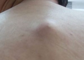 你是否了解脂肪瘤吗