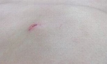 你知道乳腺脂肪瘤的病因吗