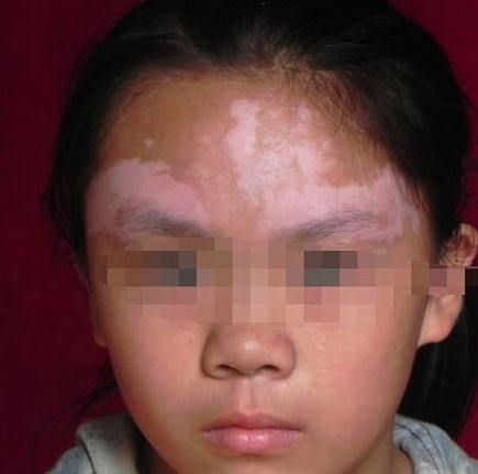 儿子脚上得了白癜风哪些因素