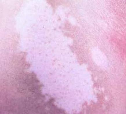 脸上有几块白斑是不是白癜风初期病情