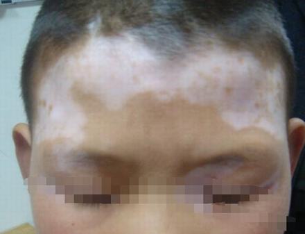 如何让白癜风不再扩散