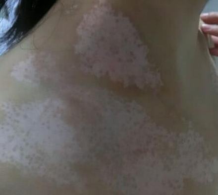手上有白斑是白癜风吗 