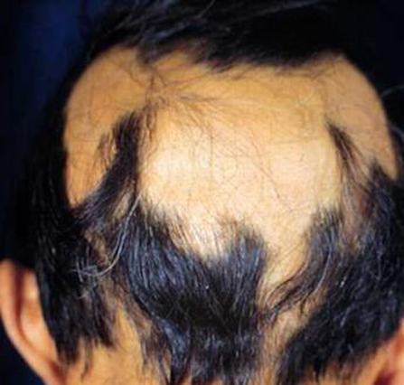 怎么正确预防斑秃发生呢