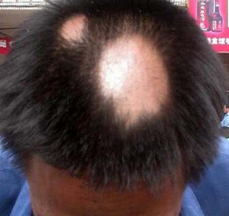 长期扎马尾容易导致斑秃或秃发
