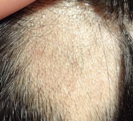 治疗斑秃最快的办法有什么