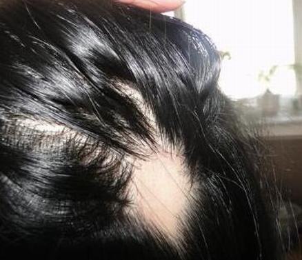 治女性斑秃什么偏方较好
