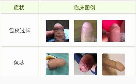 治疗包皮过长 哪家医院更好 