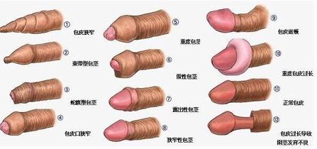 治疗包皮过长的权威医院 