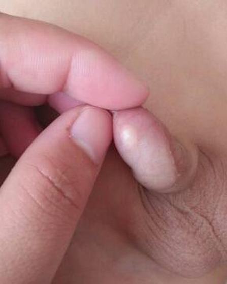 治疗包皮过长哪家医院权威