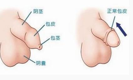 包茎和包皮过长有什么损害