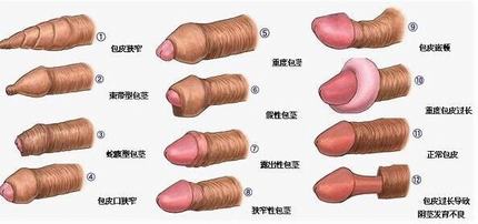 包皮过长的治疗的手法