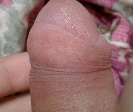包皮过长的自我检测措施