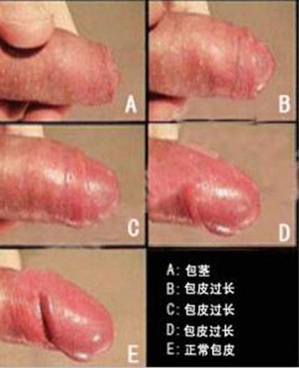 包皮过长对男性有哪些影响