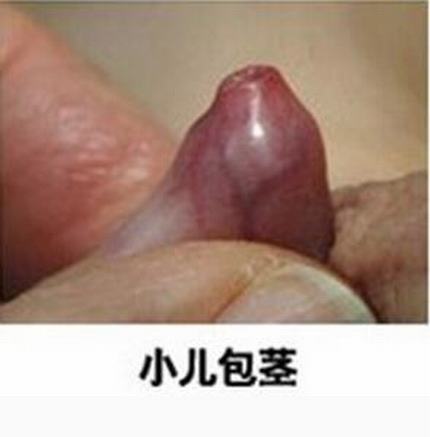 包皮过长会给男性造成什么危害呢
