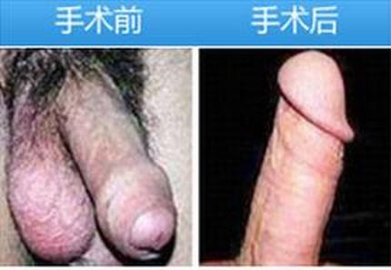 包皮过长会造成的伤害有什么