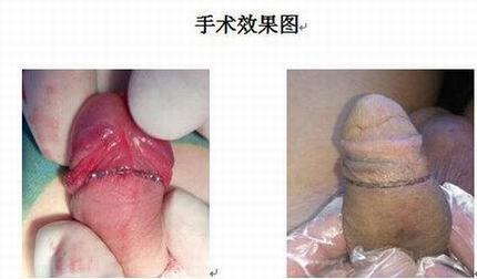 包皮过长如何治疗最好呢