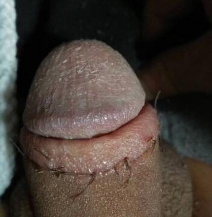 包皮过长手术后如何护理呢