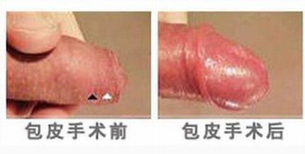 包皮过长需要做哪些化验检查
