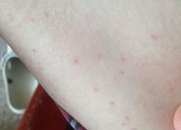星星专家详解早期性病淋巴肉芽肿