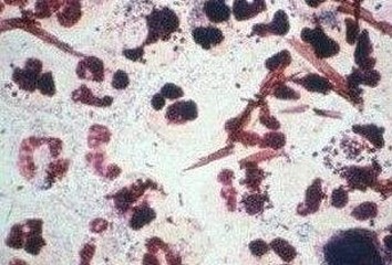 性病传播感染无症状