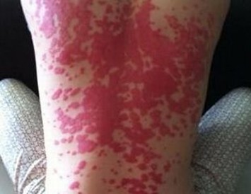 性病患者常见哪些症状