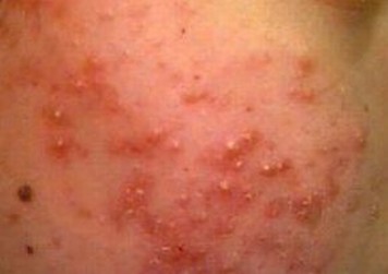 性病淋巴肉芽肿有哪些临床特点