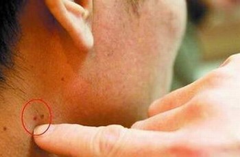 得了性病究竟有多糟