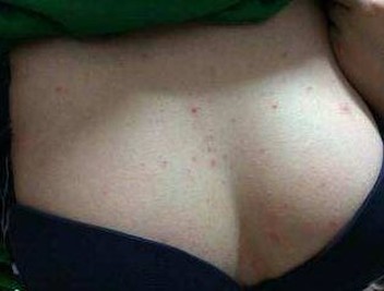 女性尿道口周围红色水泡是性病吗