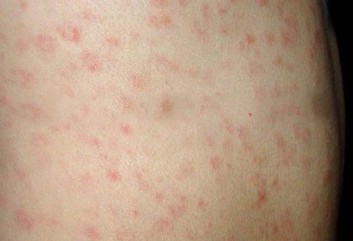 青岛哪家医院治疗性病好