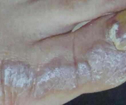 扁平苔癣的食疗