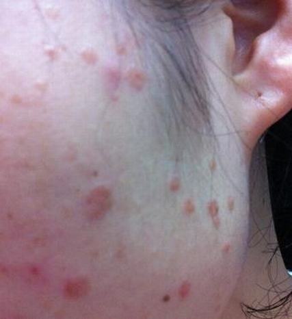口腔扁平苔藓要因人而治
