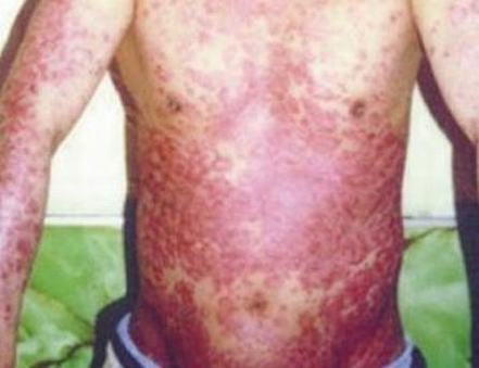 艾滋病感染早期的症状_艾滋病