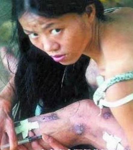 艾滋病的急性感染期特点介绍_艾滋病