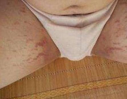 股癣对人体有什么伤害