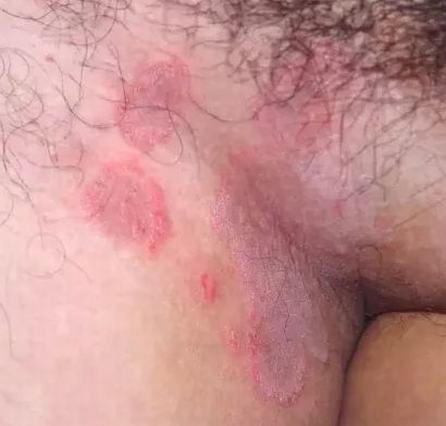 股癣该怎么进行诊断检查